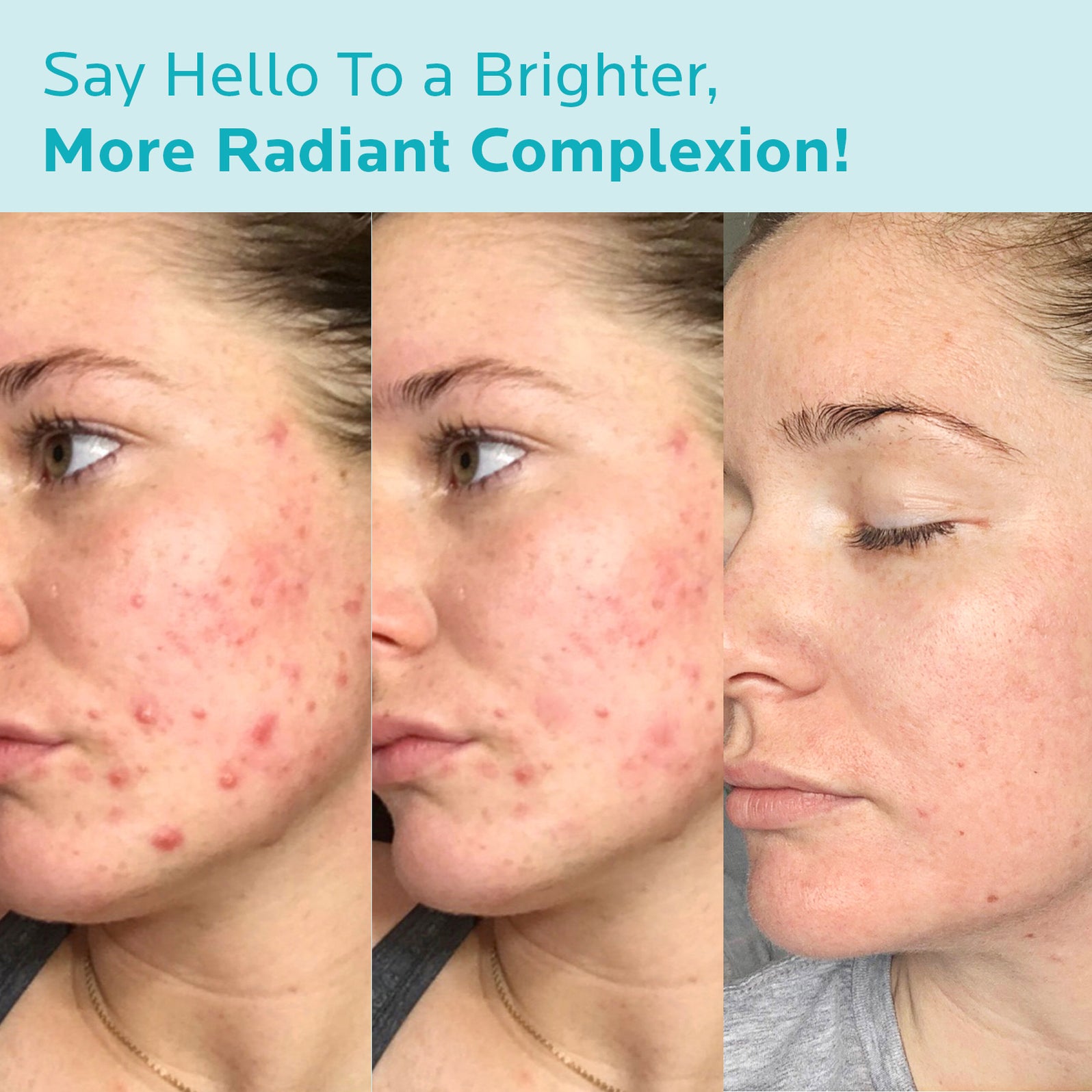 ZealSea Azelaic Acid 10 Facial Cream 1 Oz